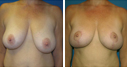 Before & After Photos